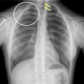 PA chest radiograph shows absent clavicles (white circle), dysplastic scapulae (white arrow), and multiple arch fusion defect