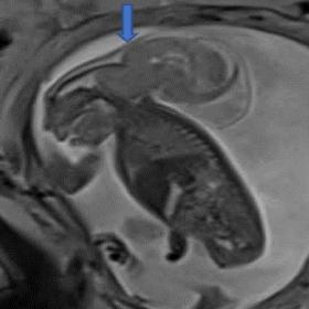 MRI T2W sagittal image shows a well-defined hyperintense lesion (arrow) with internal content isointense to the brain parench