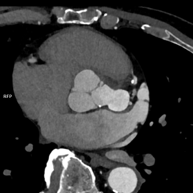 ECG-gated contrast-enhanced cardiac CT scan showing a saccular Sinus of Valsalva aneurysm, (a) reformatted plane parallel to 