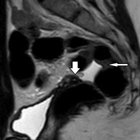 Sagittal T2-weighted image reveals absence of a normal uterus and cervix between urinary bladder and rectum. A small, triangu