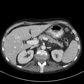 Axial MDCT image of the upper abdomen with oral and IV contrast.  The spleen is normal in size, the gastric wall appears norm