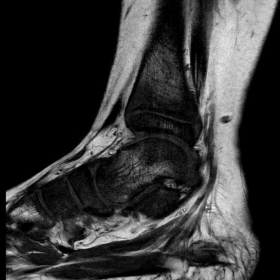 Sagittal left foot and ankle MRI shows bone marrow replacement involving tarsal bones and distal tibial metaphysis and epiphy