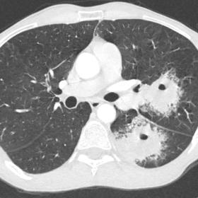 CT scan of the lungs in a 37-year-old male, showing two excavated masses with peripheral ground glass opacities in the left u