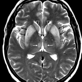 Axial plane T2-weighted TSE magnetic resonance image. Bilateral and symmetric hyperintensity of the putamen nucleus (black ar