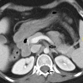 Contrast-enhanced CT images of the abdomen are shown in the axial, coronal, sagittal, and coronal-oblique planes (a-d, respec