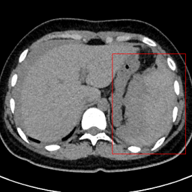 Multi-planner reformatted of abdominal CT shows spleen rupture and massive blood accumulation in the abdominal cavity