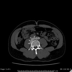 Axial contrast-enhanced CT at the level of L4 showing the retro-caval course of the anomalous right-sided retro-psoas iliac a