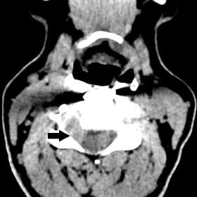 Axial cervical spine CT showing a mass in right foramen of C3-C5 level (arrow)