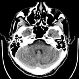 Non-enhanced computed tomography of the brain showed no evidence of acute infarct in the pontine region.