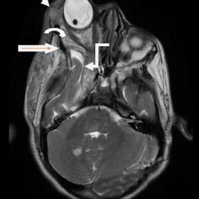 T2 axial view at orbital apex level reveals severe right sphenoid wing bone dysplasia (marked with a long arrow). Exophthalmos and buphthalmos of right eyeball seen with dislocated right eye lens and retinal detachment (marked with small arrow). Note heterogenous soft tissue intensity lesion in right cavernous sinus (marked with elbow arrow). T2 hypointense central focus (target sign) is also seen (marked with a curved arrow).