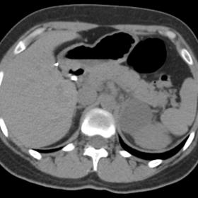 Axial non-enhanced CT image shows a well-defined homogeneously and hypoattenuating (13 HU) mass on the left retroperitoneum between the left suprarenal gland and the homolateral kidney. Calcifications were not present.