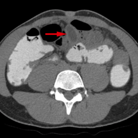 Axial CT images of the abdomen and pelvis obtained at different levels (a, b and c) with oral and intravenous contrast materi