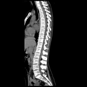 CT shows adequate alignment of all vertebral bodies. No immediately apparent changes with a significant impact on the spinal 