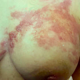 Photograph of the left breast depicting breast erythema and peau d’orange
