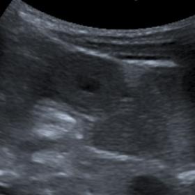 Abdominal ultrasound – thickened bowel loops in the left medium quadrant of the abdomen