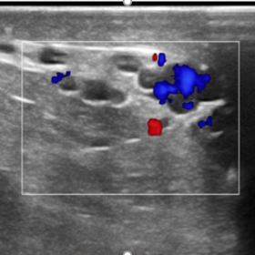 USG image of left scrotum showing grade-IV varicocele