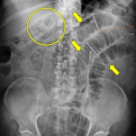 Supine x-ray film shows dilated gas-filled segments of small intestine (yellow arrows) and metallic clips (yellow circle) on the right upper quadrant