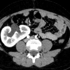 Axial CT urography image in corticomedullary phase showing crossed fused renal ectopia