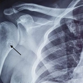 Plain radiograph anteroposterior(A) and anteroposterior with internal rotation(B) view of right shoulder showing well-defined