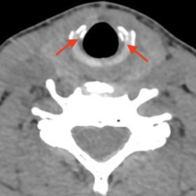 Axial CT without intravenous contrast – two visible fracture lines in the antero-lateral right and left cricoid ring (red a