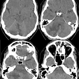 Non-contrast-enhanced brain CT shows low-density and swelling of the right cerebellar hemisphere with distortion of the fourt