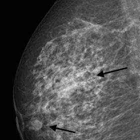 Mammography. Mediolateral oblique (MLO) view of the right breast (1a) and left breast (1b). Craniocaudal (CC) view of the rig