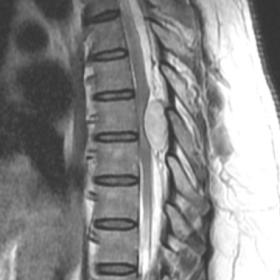 MRI dorsal spine (a)T2W sagittal (b) sagittal STIR sequences showing a well-defined oval homogenously hyperintense lesion in 