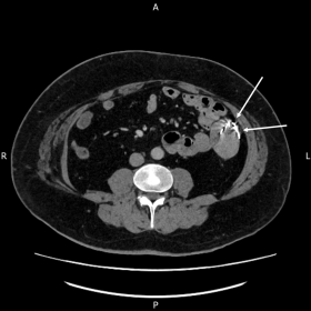 Axial portal venous phase CT demonstrating the retained swab gossypiboma within the left upper quadrant in close proximity to loops of small bowel (arrowed)