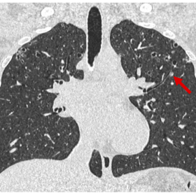 Coronal CT scan of the thorax in lung window. Description: Multiple thick-walled cystic lesions (< 10 mm) in the upper- and m