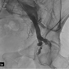 Initial venogram with the diagnostic catheter in the left internal pudendal vein