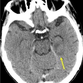 Contrast-enhanced brain CT at admission. Axial and coronal views show mild hypodensity of the left hippocampus (arrows)