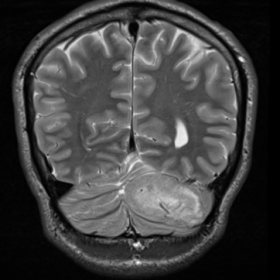 Typical “tigroid pattern” in T2WI and mass effect with enlargement of left cerebellar lobe