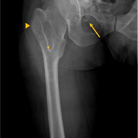 AP right femur. 10 cm-wide exophytic mass emerging from the anterior wall of the right acetabulum (arrow). A ring-and-arc cal