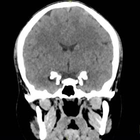 CT brain [coronal] showed bilateral symmetrical calcifications in the medial temporal lobe