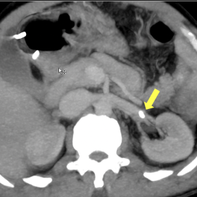 An oval hyperdense lesion of size~ 8 mm at the left renal hilum. On the venous phase, seen embedded within the lumen of left 