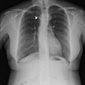 Note the enlarged superior mediastinum with a rounded morphology (arrowhead)