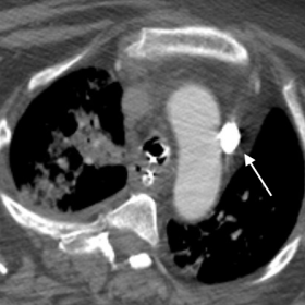 Axial CT images with contrast demonstrated an anomalous course of the left brachiocephalic vein (white arrows). The vein ente