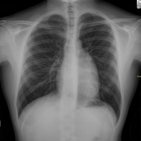 Prominent left mediastinal border (lateral projection was not performed)