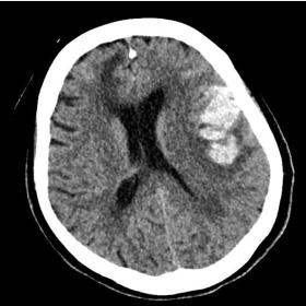 Non-contrast CT demonstrates an intracerebral hemorrhage in left parietal lobe