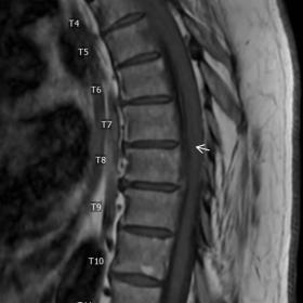 Sagittal T1-weighted imaging shows ventral extramedullary iso- to hypointense dural based mass spanning vertebral levels T1 t