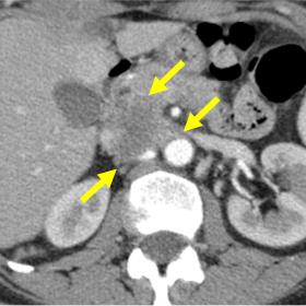 Contrast enhanced CT axial scan in the arterial phase. Solid peripancreatic hypovascular mass of 4 cm with necrotic core. The
