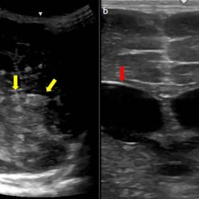 a) Ill defined hyperechoic extraaxial collection in the posterior fossa (yellow arrows) compressing the cerebellum and brains