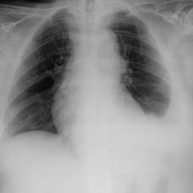 Frontal chest x-ray shows a left sided moderate pleural effusion