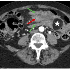 Axial CT scan of the abdomen in portal venous phase. Description: Invagination of the colon transversum (outer intussusceptum