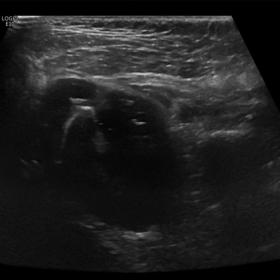 Ultrasound image of the right TMJ shows a large joint effusion with floating echogenic foci within the fluid