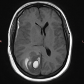 Axial T1W MRI Brain shows a relatively well-defined mixed signal intensity lesion with isointense and hyperintense areas with