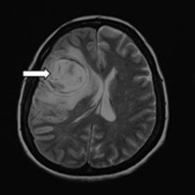 A) T2-axial image and B) coronal FLAIR image showing a rounded hematoma with surrounding oedema in the right frontal lobe cau