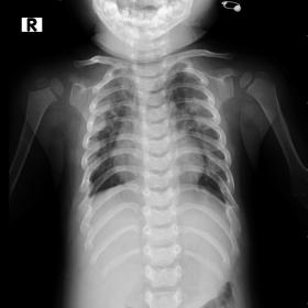 Chest radiography shows a small narrow chest, high up clavicle, horizontal and short ribs