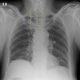 Chest radiograph (PA view) showed an encapsulated lesion with air lucency extending from the apical region extending into nec