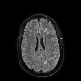 FLAIR axial image at the level of the lateral ventricles shows numerous hyperintense lesions located in the subcortical and d
